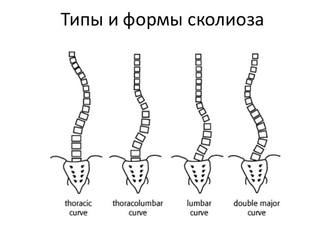 Вторичный кифоз третьей степени